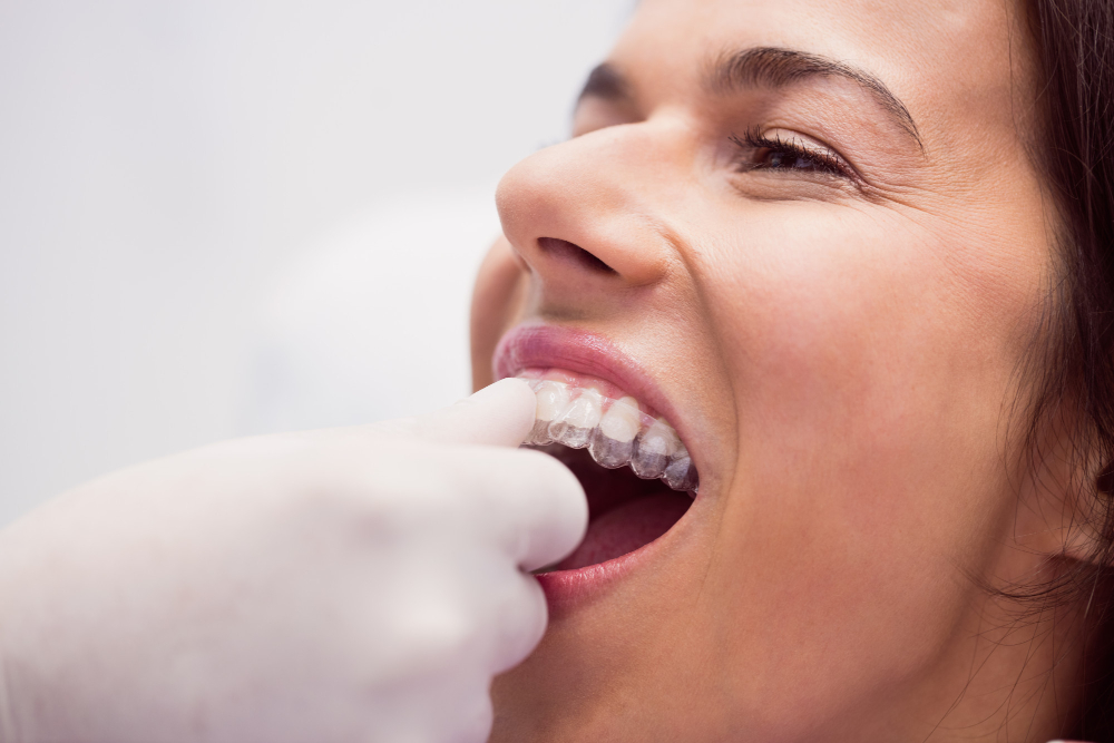 aligner