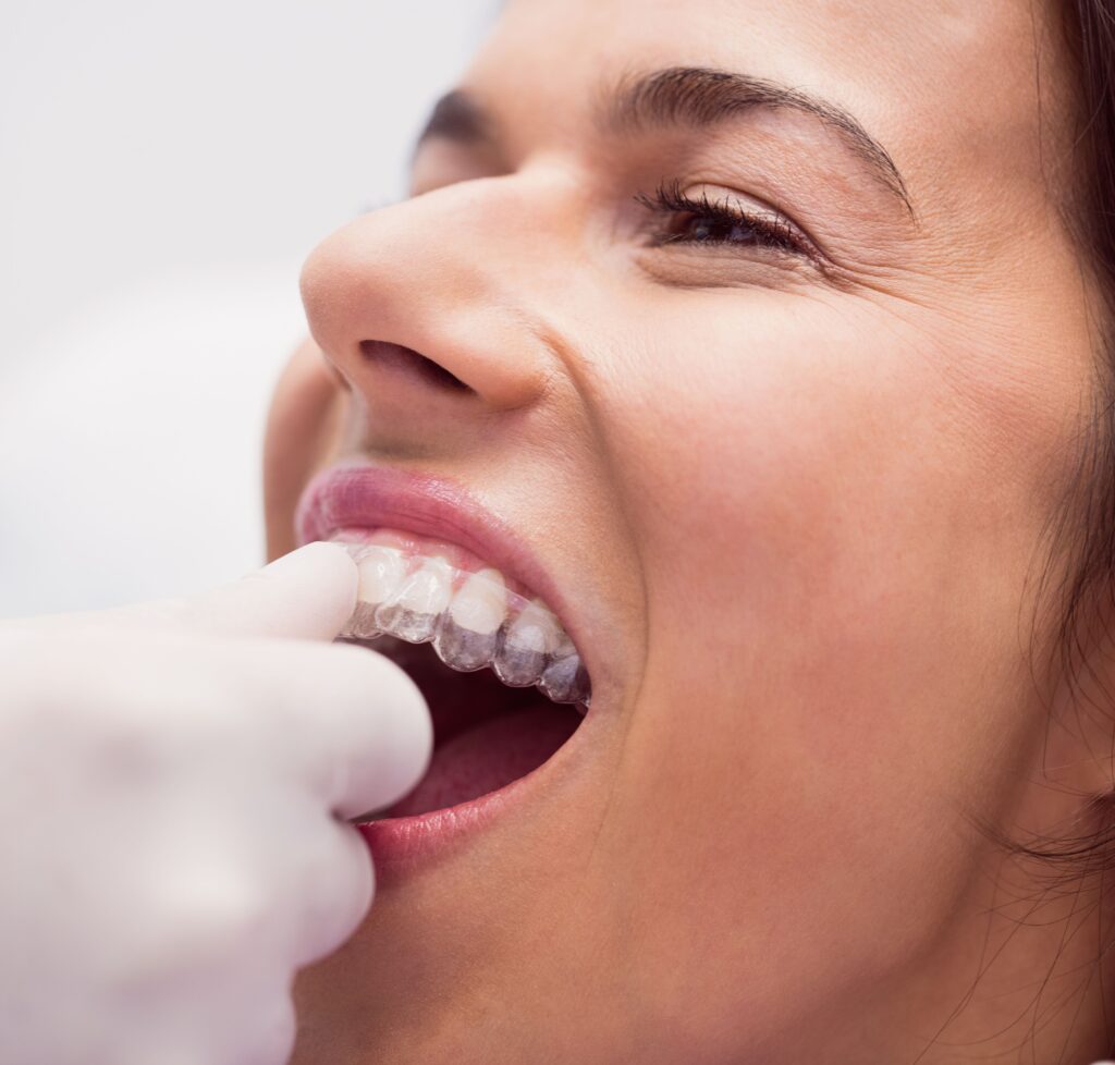 all type of aligners